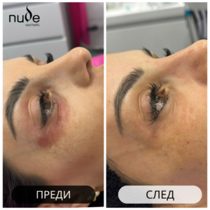 Заличаване на пигментация в околоочна зона след три процедури Микронидлинг с V-Tech Екзозоми